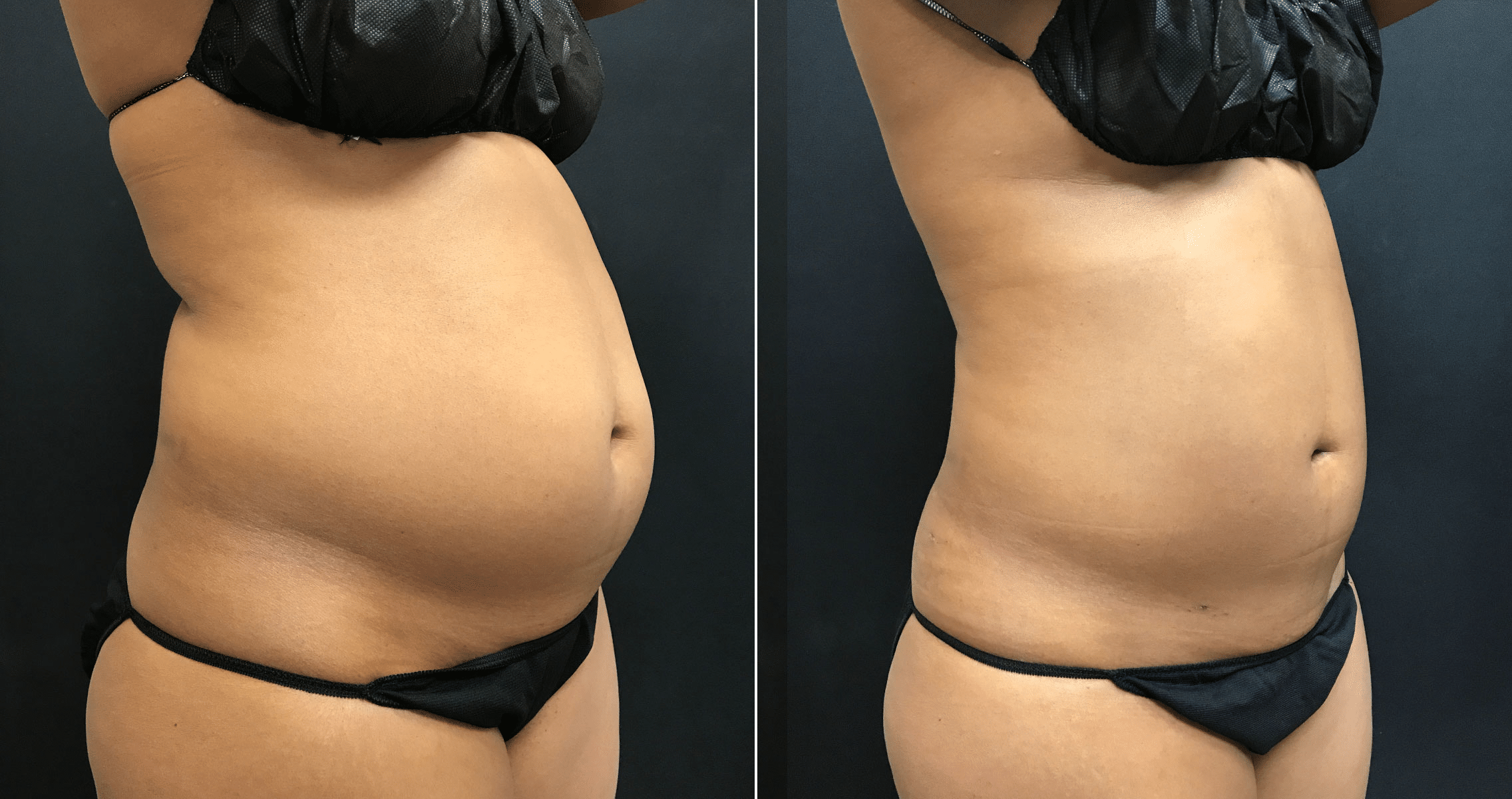 Vaser Lipo for Abdomen and Love Handles for Woman in Her 40's