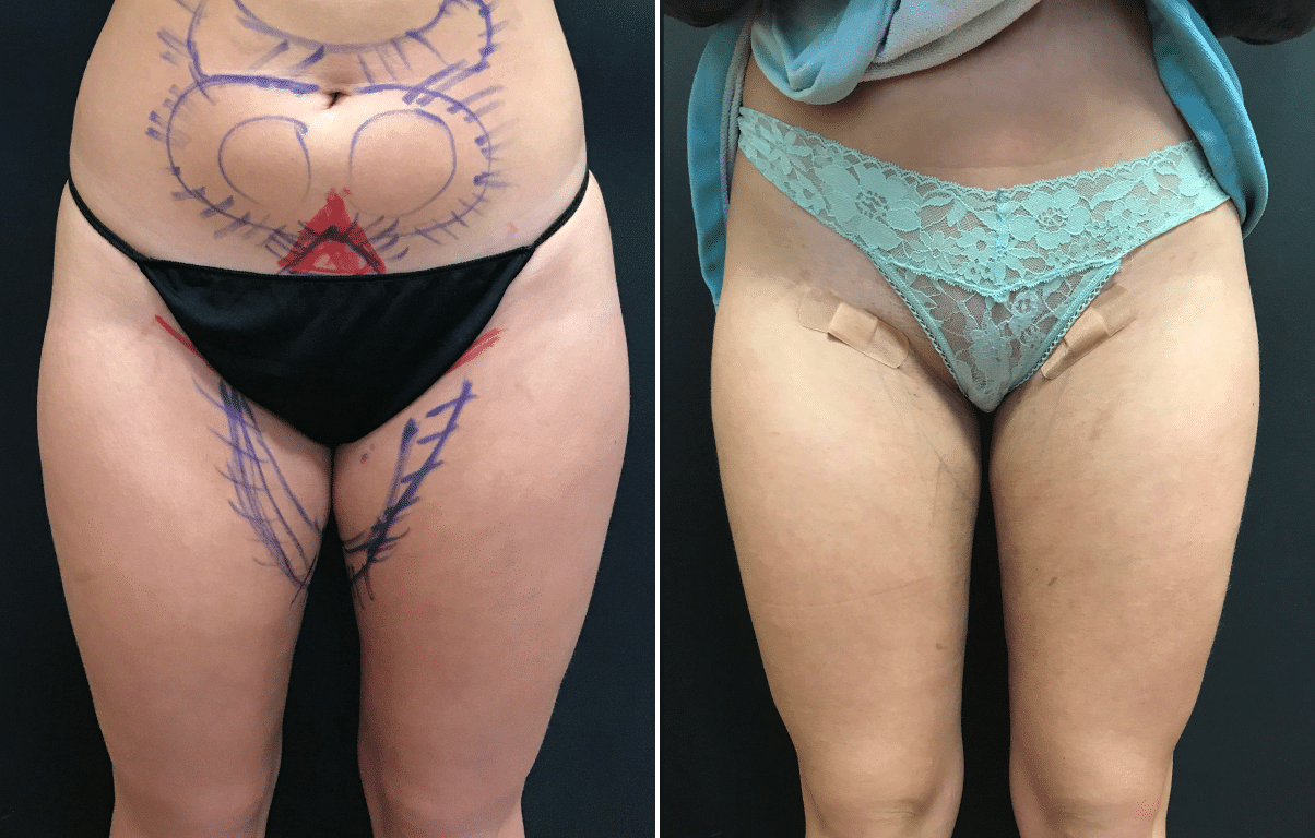 Thighs + Saddlebags Before & After Photos New Jersey | Reflections
