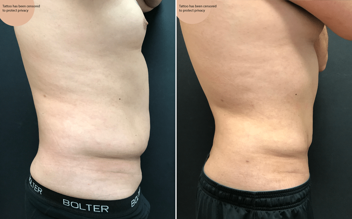 Male Abs Liposuction