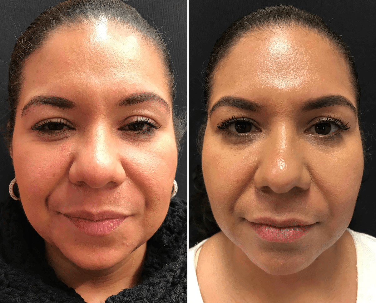 The Microneedling Rundown With Before and After Photos – Perfect Face  Aesthetic Medicine