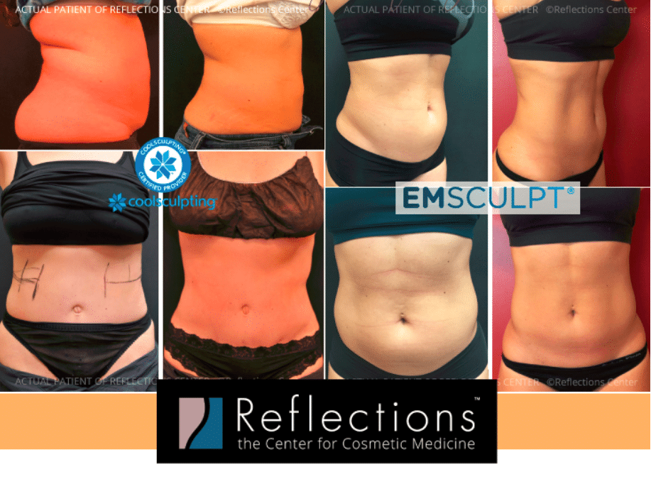 Differences of EmSculpt & CoolSculpting