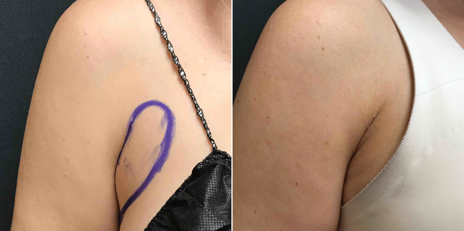 Bra Rolls / Back Fat Before & After Photos New Jersey