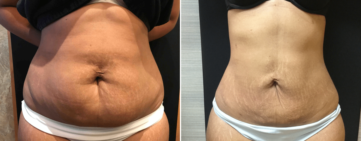 Smartlipo Skin Tightening for Mom (Tummy Tuck Alternative) Before