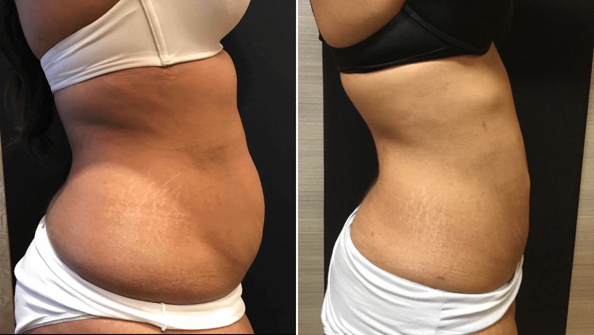 Smartlipo Skin Tightening for Mom (Tummy Tuck Alternative) Before & After  Photos New Jersey - Reflections Center