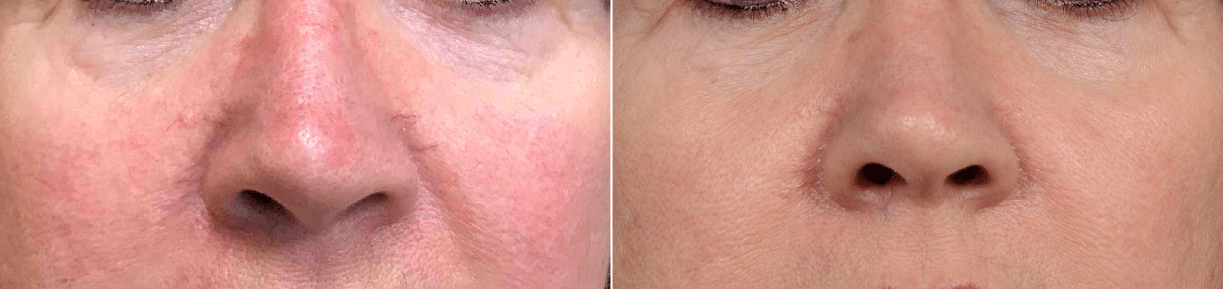 Vbeam for Red Capillaries Around Nose Before & After Photos New Jersey - Reflections Center