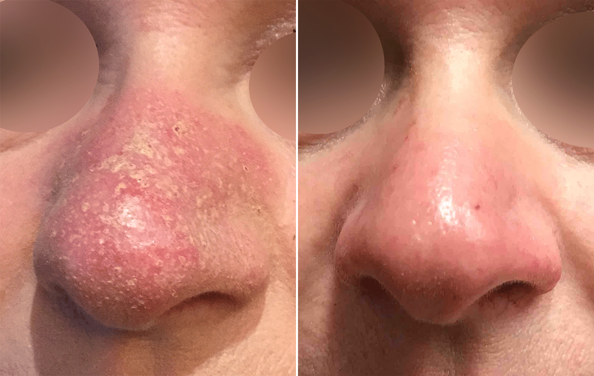 Crack pot Maxim Met name Vbeam Rosacea Treatment Before & After Photos New Jersey - Reflections  Center