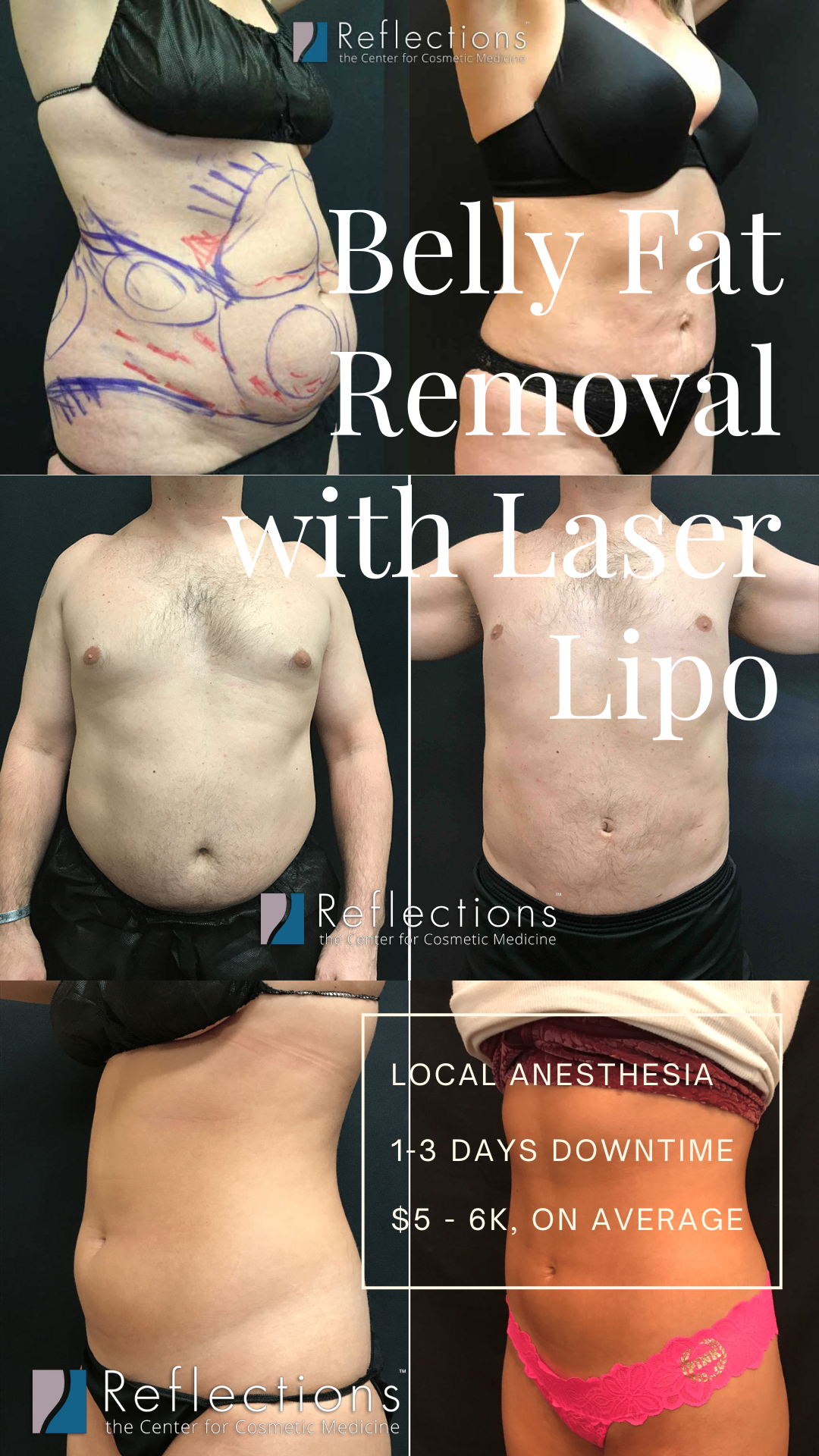 Achieving a Flatter Stomach with Lipolysis Injections