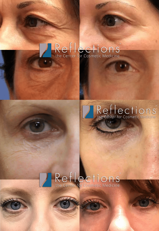 Reason And Treatment For Bags Under Eyes