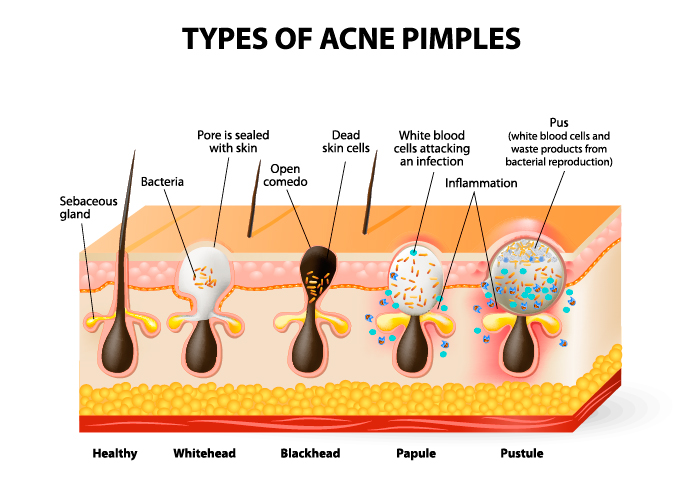 types of acne explained