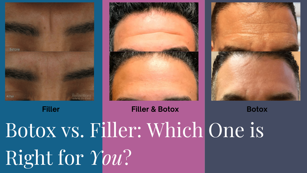 Botox vs. Filler for Wrinkles Which is Best? Reflections Center