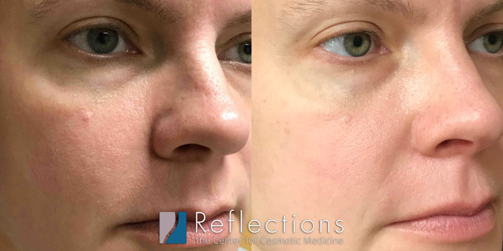 Microneedling-PRP-Pore-Refinement-7248-46yo-Caucasian-SkinType2-Woman-ObliqueView