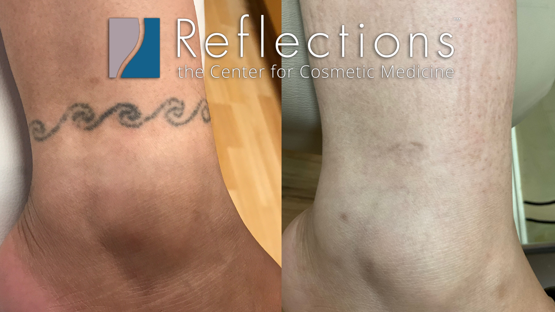 Ankle Wave Tattoo Removed with 3 Sessions of PiQo4 Laser Tattoo Removal for Asian Woman Before & After Photos New Jersey - Reflections Center