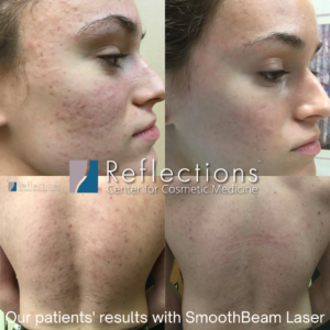SmoothBeamAcne Laser Before and Afters Reflections Center NJ