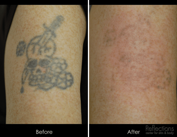 Best Tattoo Removal Treatments Near Me NJ | Laser Tattoo Removal Cost