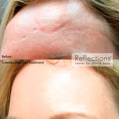 Vancouver Fractional CO2 Laser  Skin Resurfacing Surrey, Delta, Langley