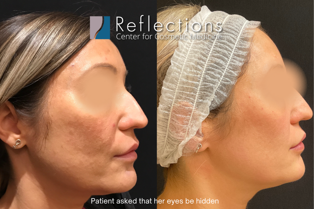 Ooze Apparently rape Clear + Brilliant Laser for Clear & Brilliant Skin Over 40 Before & After  Photos New Jersey - Reflections Center