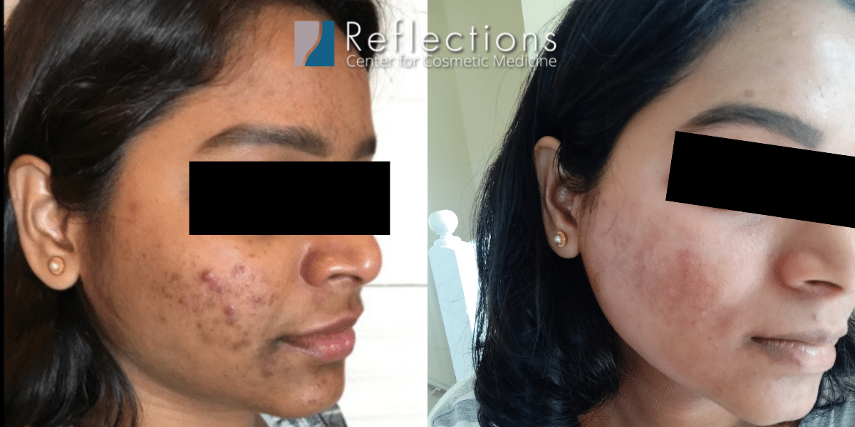 Acne Scars Before & After Photos New Jersey