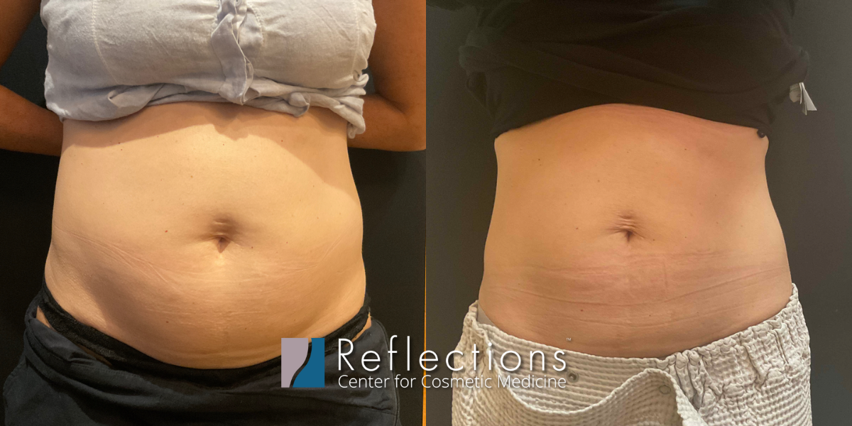 Coolsculpting Before And After