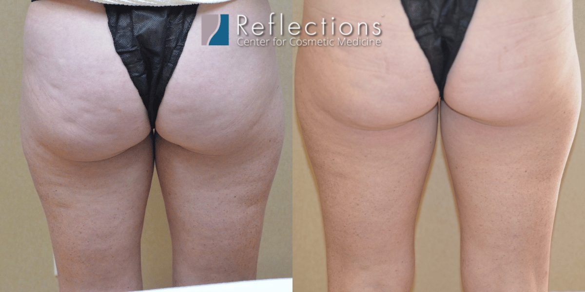 Cellulite Results, Before and After