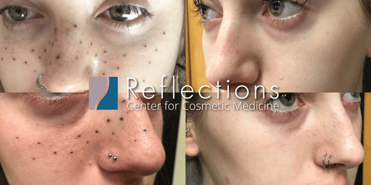 Tattooed Freckles Permanent Makeup Tattoo Removal Before & After Photos New  Jersey - Reflections Center