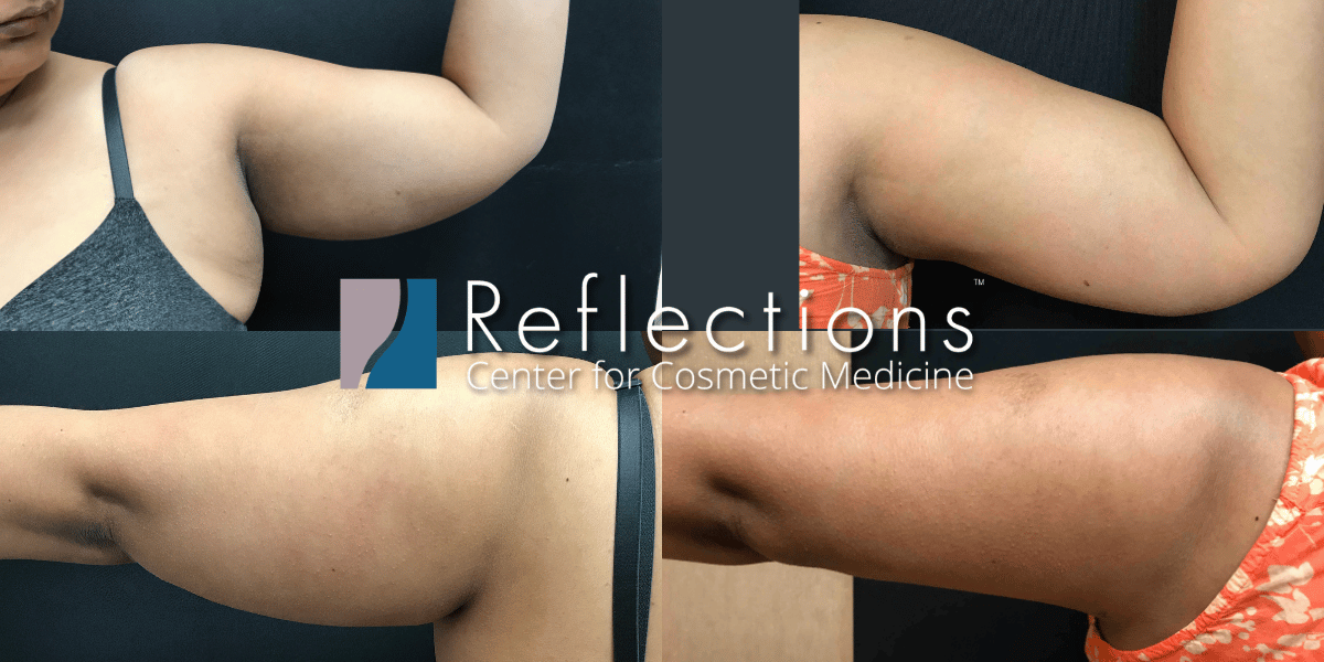 Laser Liposuction Before & New Jersey | Reflections