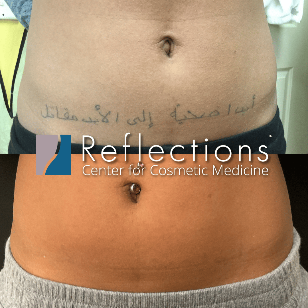 Laser Tattoo Removal Before & After Photos New Jersey | Reflections