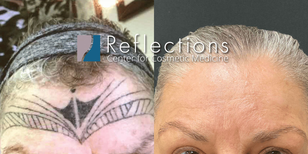 Laser Tattoo Removal Before & After Photos New Jersey