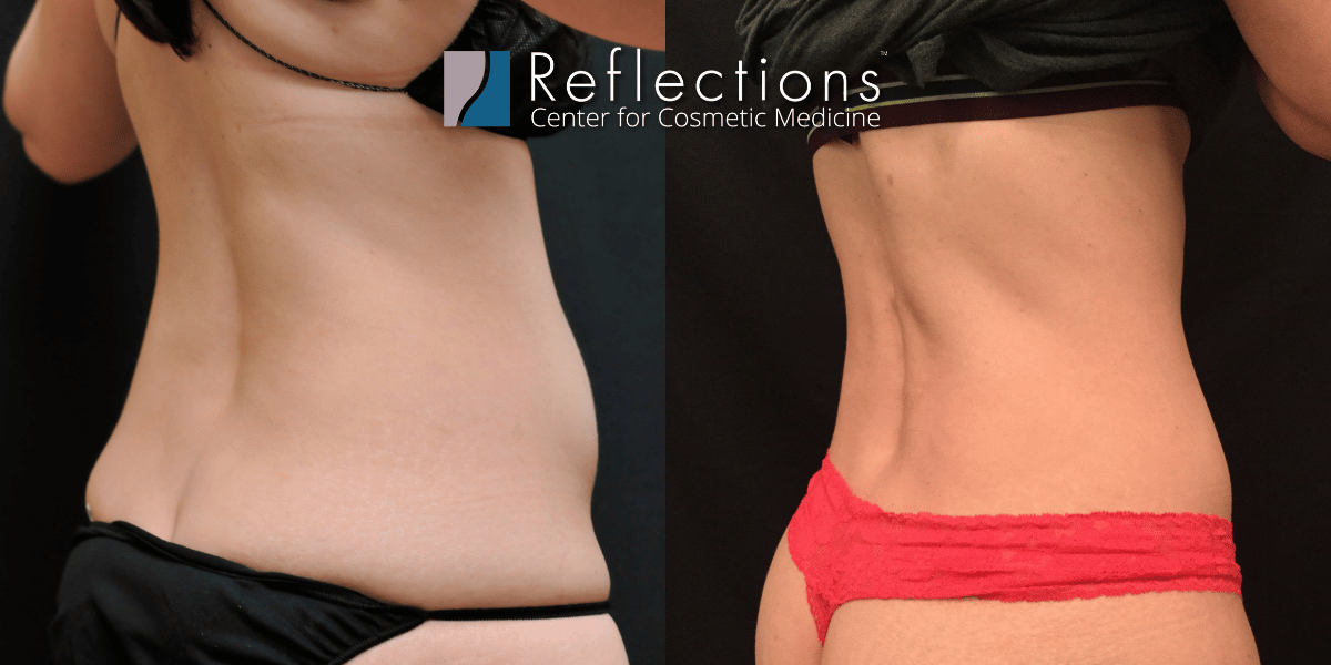Laser Lipo 360 for Slim, Toned Abs & Love Handles Before & After Photos New  Jersey - Reflections Center