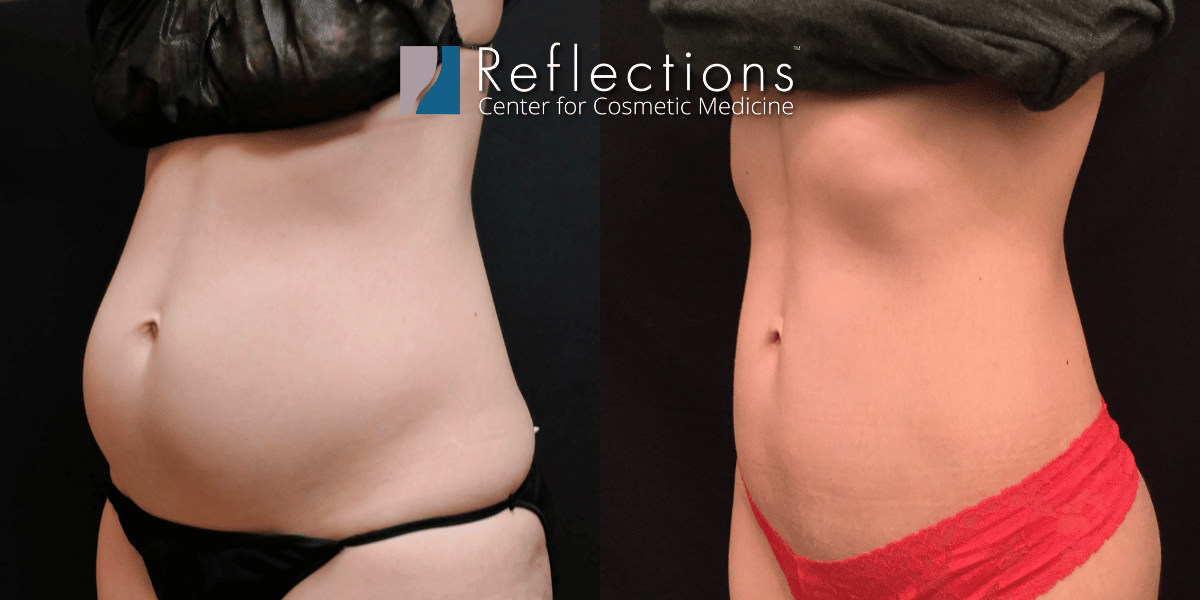 Smartlipo Flanks Liposuction for Women - Before & After Photos