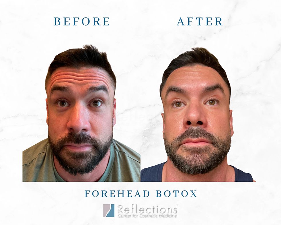 Forehead Botox 39-yo Male Before & After Photos New Jersey ...