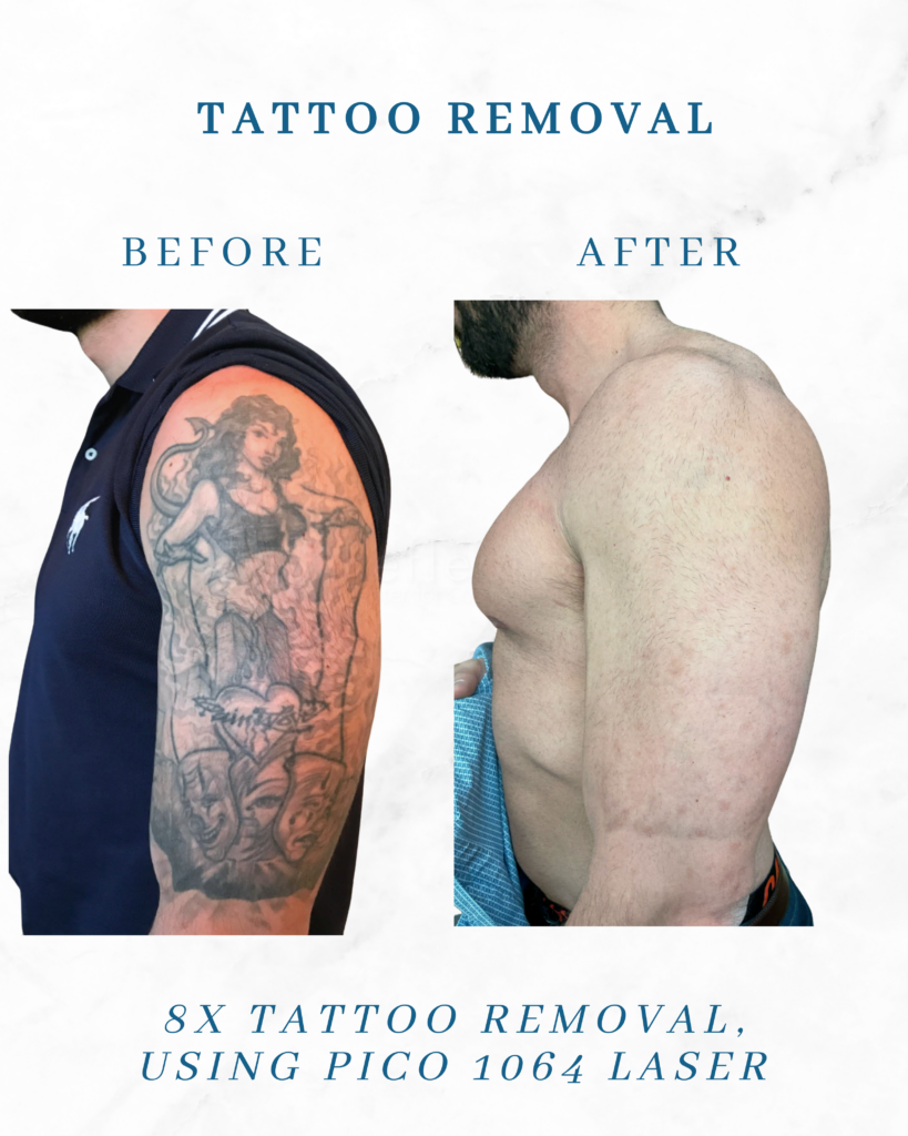 Tattoo Removal Pico Laser 41 yo male Before & After Photos New Jersey ...