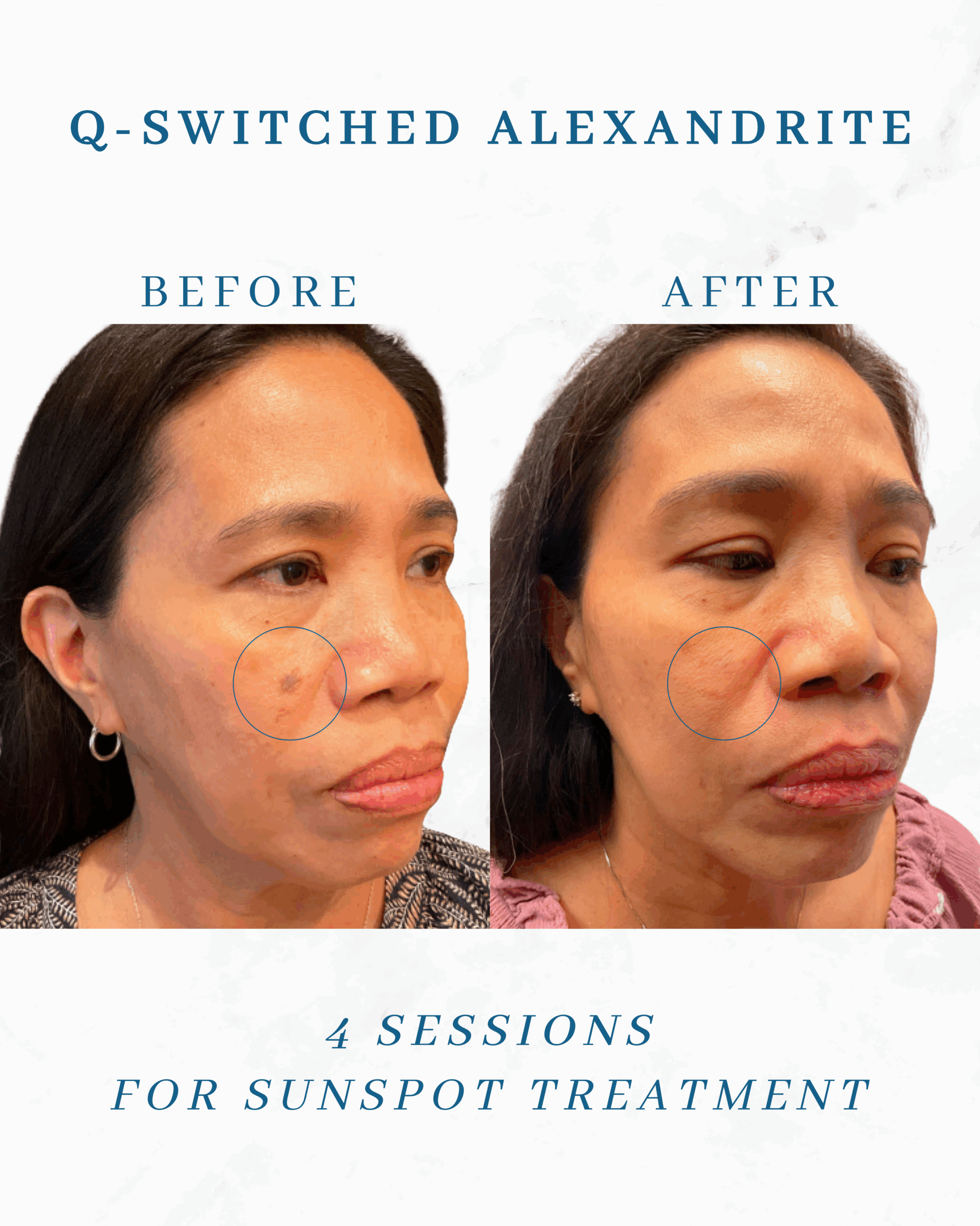 Q-Switched Lasers Before & After Photos New Jersey | Reflections