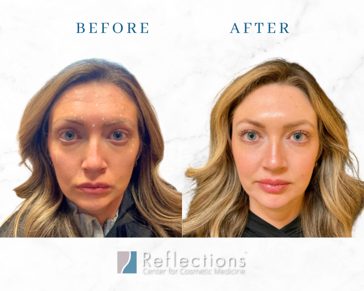 Botox at Reflections Center for Cosmetic Medicine