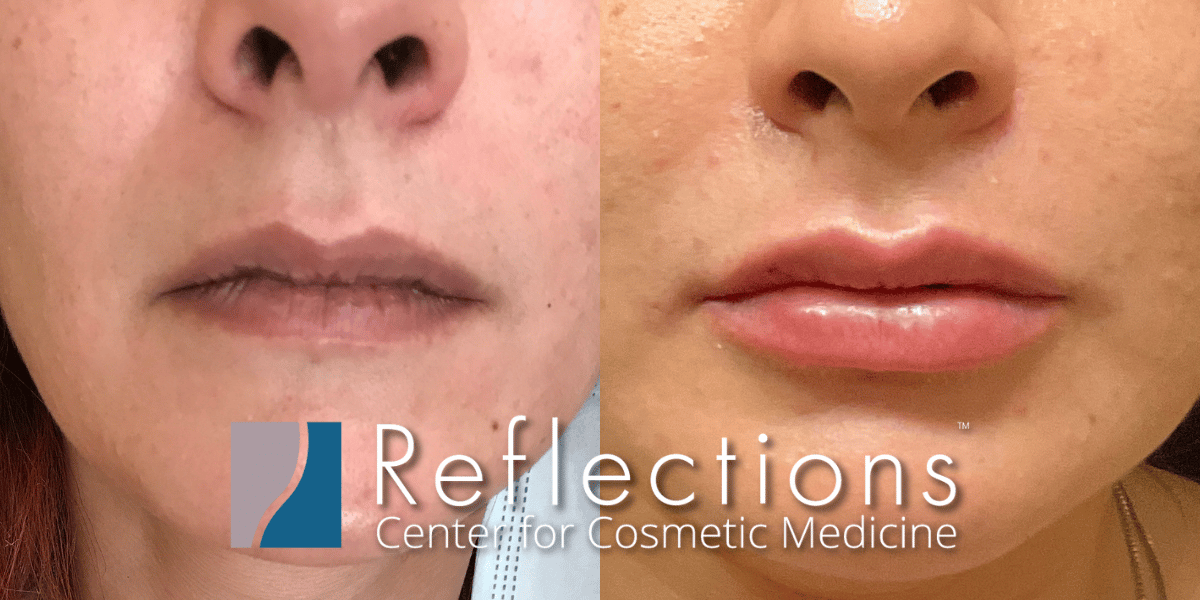 Dermal filler at Reflections Center for Cosmetic Medicine
