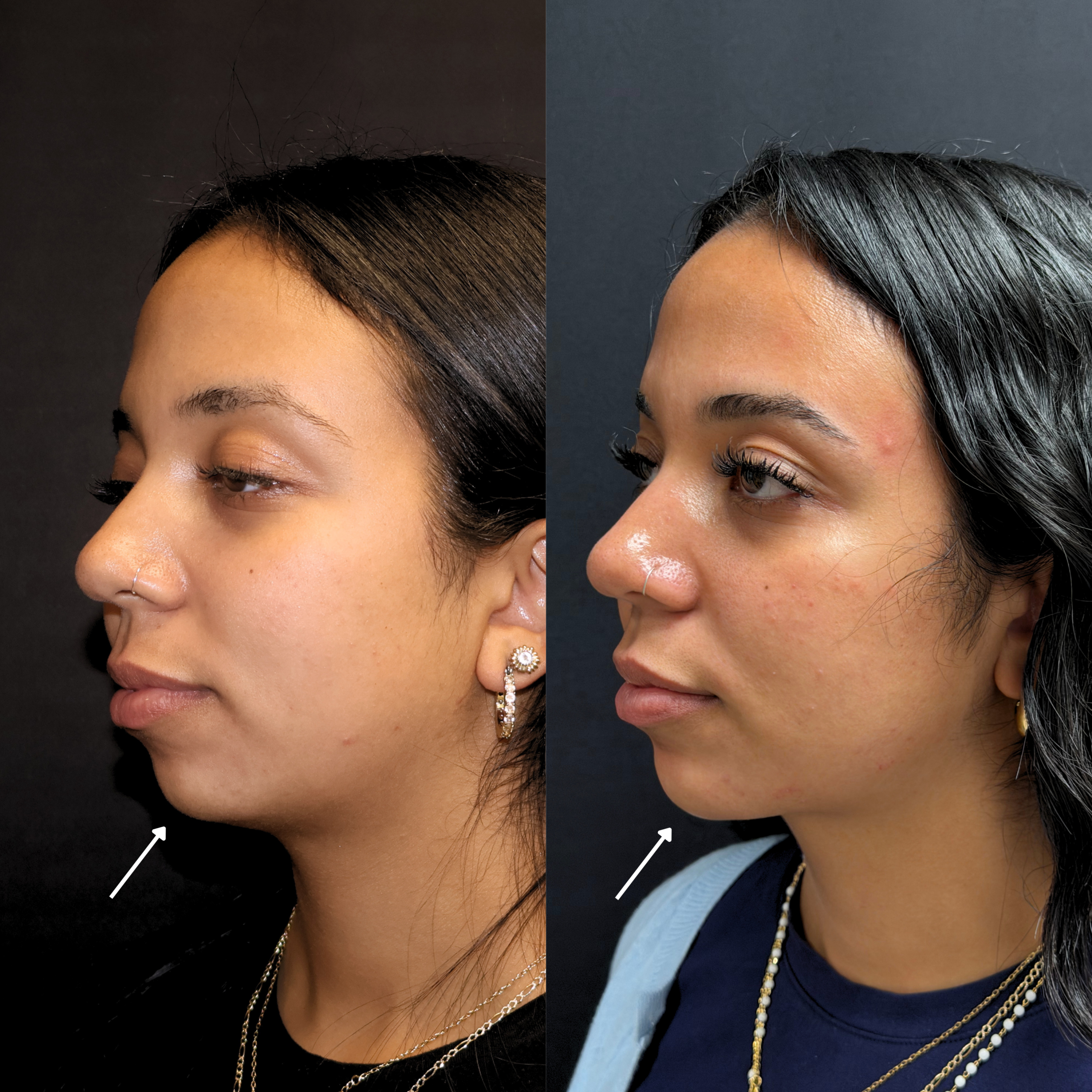 lipo c shot before and after Laser Liposuction & Photos New Jersey Vitamin B12 Injections: What Minimum order size:Price 2700/pack for 1-5 packs Healthy Lifestyle_Energy